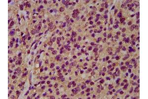 IHC image of ABIN7161362 diluted at 1:200 and staining in paraffin-embedded human glioma performed on a Leica BondTM system. (NrCAM 抗体  (AA 1194-1299))