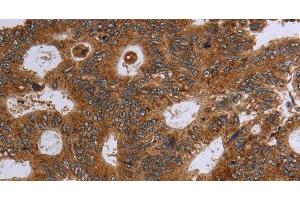 Immunohistochemistry of paraffin-embedded Human colon cancer using HSD17B4 Polyclonal Antibody at dilution of 1:30 (HSD17B4 抗体)