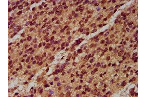 IHC image of ABIN7160831 diluted at 1:400 and staining in paraffin-embedded human glioma performed on a Leica BondTM system. (NLRP6 抗体  (AA 154-306))