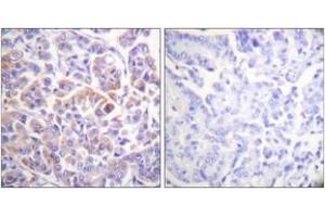 Immunohistochemistry analysis of paraffin-embedded human breast carcinoma tissue, using C-RAF (Ab-296) Antibody. (RAF1 抗体  (AA 271-320))