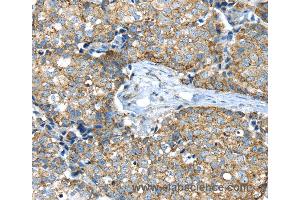 Immunohistochemistry of Human colon cancer using IFNA2 Polyclonal Antibody at dilution of 1:40 (IFNA2 抗体)
