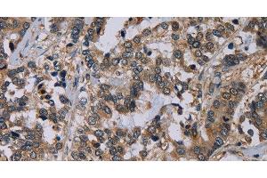 Immunohistochemistry of paraffin-embedded Human liver cancer using NECTIN4 Polyclonal Antibody at dilution of 1:60 (PVRL4 抗体)