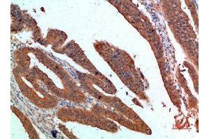 Immunohistochemical analysis of paraffin-embedded human-colon-cancer, antibody was diluted at 1:200 (PDGFC 抗体  (AA 61-110))