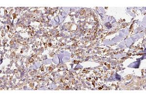 ABIN6276766 at 1/100 staining Human Melanoma tissue by IHC-P. (SPARC 抗体  (Internal Region))