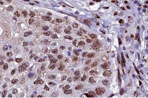 ABIN6266678 at 1/100 staining human lung carcinoma tissue sections by IHC-P. (XRCC3 抗体  (N-Term))