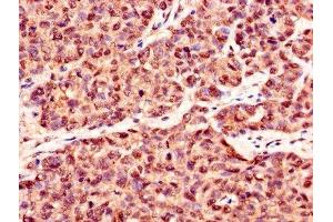 Immunohistochemistry of paraffin-embedded human ovarian cancer using ABIN7146893 at dilution of 1:100 (CSNK2B 抗体  (AA 1-215))