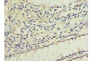Immunohistochemistry of paraffin-embedded human colon cancer using ABIN7154311 at dilution of 1:100 (GS28 抗体  (AA 1-115))