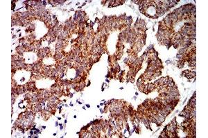 Immunohistochemistry (IHC) image for anti-Protein tyrosine Phosphatase, Non-Receptor Type 14 (PTPN14) (AA 896-1169) antibody (ABIN5542696)