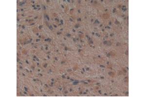 Detection of NOG in Human Glioma Tissue using Monoclonal Antibody to Noggin (NOG) (NOG 抗体  (AA 28-232))