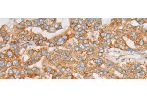 Immunohistochemistry of paraffin-embedded Human liver cancer tissue using ATXN7 Polyclonal Antibody at dilution of 1:60(x200) (ATXN7 抗体)