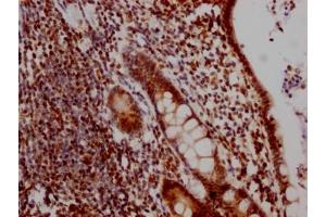 IHC image of ABIN7127450 diluted at 1:100 and staining in paraffin-embedded human colon cancer performed on a Leica BondTM system. (Recombinant DDX5 抗体)