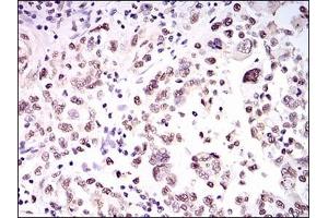 Immunohistochemical analysis of paraffin-embedded human endometrial cancer tissues using HNRNPU mouse mAb with DAB staining. (HNRNPU 抗体)