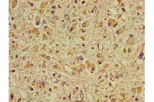 Immunohistochemistry of paraffin-embedded human glioma using ABIN7149930 at dilution of 1:100 (DPYSL2 抗体  (AA 1-572))