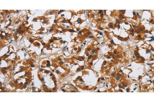 Immunohistochemistry of paraffin-embedded Human thyroid cancer tissue using DSP Polyclonal Antibody at dilution 1:40 (Desmoplakin 抗体)
