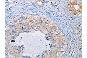 The image on the left is immunohistochemistry of paraffin-embedded Human cervical cancer tissue using ABIN7128287(AGBL5 Antibody) at dilution 1/30, on the right is treated with fusion protein. (AGBL5 抗体)