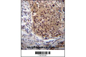 EXTL3 Antibody immunohistochemistry analysis in formalin fixed and paraffin embedded human esophageal carcinoma followed by peroxidase conjugation of the secondary antibody and DAB staining. (EXTL3 抗体  (N-Term))