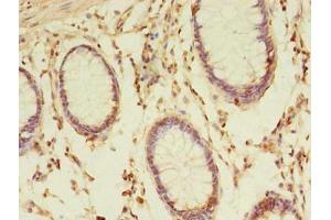 Immunohistochemistry of paraffin-embedded human colon cancer using ABIN7172979 at dilution of 1:100 (TMED3 抗体  (AA 24-180))