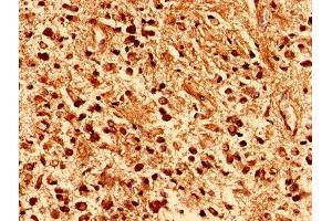 Immunohistochemistry analysis of human glioma using ABIN7163605 at dilution of 1:100