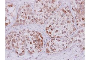 IHC-P Image STMN2 antibody detects STMN2 protein at cytoplasm on human liver carcinoma by immunohistochemical analysis. (STMN2 抗体  (N-Term))