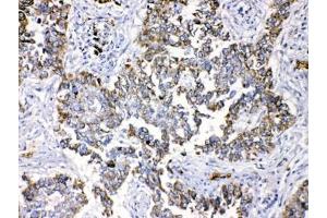 IHC testing of FFEP human lung cancer tissue with Periplakin antibody at 1ug/ml. (PPL 抗体  (AA 1664-1701))