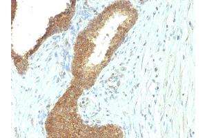 Formalin-fixed, paraffin-embedded human Colon Carcinoma stained with Alkaline Phosphatase Mouse Monoclonal Antibody (ALPL/597). (ALPL 抗体)