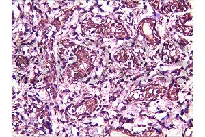 Formalin-fixed and paraffin embedded human breast carcinoma labeled with Anti-BRMS-1 Polyclonal Antibody, Unconjugated (ABIN730933) at 1:200, followed by conjugation to the secondary antibody and DAB staining (BRMS1L 抗体  (AA 151-246))