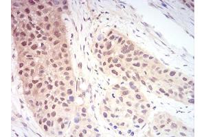 Immunohistochemical analysis of paraffin-embedded esophageal cancer tissues using RAN mouse mAb with DAB staining. (RAN 抗体  (AA 1-216))