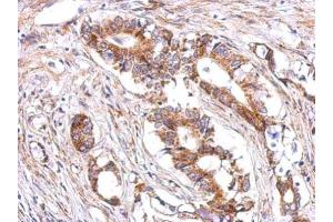 IHC-P Image Immunohistochemical analysis of paraffin-embedded human gastric cancer, using LHR, antibody at 1:500 dilution. (LHCGR 抗体  (C-Term))