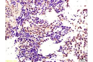 Formalin-fixed and paraffin embedded human lung carcinoma labeled with Anti-CENPH Polyclonal Antibody, Unconjugated (ABIN717491) at 1:200 followed by conjugation to the secondary antibody and DAB staining. (CENPH 抗体  (AA 41-140))