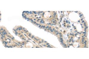 Immunohistochemistry of paraffin-embedded Human thyroid cancer using VPS26A Polyclonal Antibody at dilution of 1/40 (VPS26A 抗体)