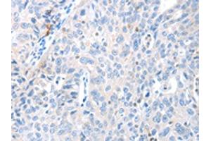 The image on the left is immunohistochemistry of paraffin-embedded Human ovarian cancer tissue using ABIN7130139(MAGEB4 Antibody) at dilution 1/40, on the right is treated with fusion protein. (MAGEB4 抗体)