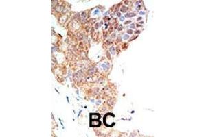 Formalin-fixed and paraffin-embedded human cancer tissue reacted with the primary antibody, which was peroxidase-conjugated to the secondary antibody, followed by DAB staining. (PRMT5 抗体  (C-Term))