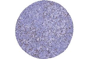Hodgkins lymphoma containing numerous reactive CTLA 4 positive lymphocytes (Recombinant CTLA4 抗体)