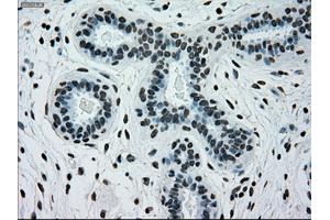 Immunohistochemical staining of paraffin-embedded breast tissue using anti-SILV mouse monoclonal antibody. (Melanoma gp100 抗体)