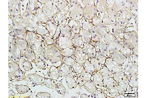 Formalin-fixed and paraffin embedded human colon carcinoma tissue labeled with Rabbit Anti-RAB7 Polyclonal Antibody (ABIN720191) at 1:200 followed by conjugation to the secondary antibody and DAB staining. (RAB7A 抗体  (AA 101-207))