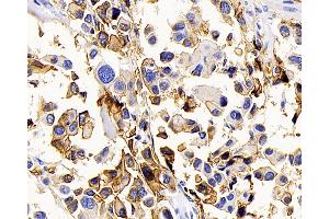 Immunohistochemistry analysis of paraffin-embedded human lung cancer using AQP1 Polyclonal Antibody at dilution of 1:400. (Aquaporin 1 抗体)