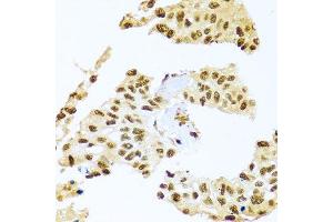 Immunohistochemistry of paraffin-embedded human lung cancer using SMEK1 antibody (ABIN5974870) at dilution of 1/100 (40x lens). (SMEK1 抗体)