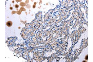 Immunohistochemistry of Human stomach cancer using UTS2 Polyclonal Antibody at dilution of 1:100 (Urotensin 2 抗体)