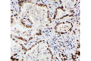 IHC-P: Lamin A/C antibody testing of human lung cancer tissue (Lamin A/C 抗体  (AA 455-469))