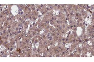 ABIN6277556 at 1/100 staining Human liver cancer tissue by IHC-P. (PVRL2 抗体  (Internal Region))