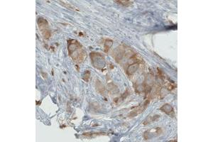 Immunohistochemical staining (Formalin-fixed paraffin-embedded sections) of human breast cancer with PHGDH monoclonal antibody, clone CL0555  shows moderate cytoplasmic immunoreactivity in tumor cells. (PHGDH 抗体)