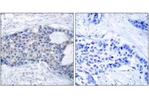 Immunohistochemistry analysis of paraffin-embedded human breast carcinoma, using ZAP-70 (Phospho-Tyr493) Antibody. (ZAP70 抗体  (pTyr493))