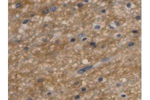 Detection of AQP4 in Human Glioma Tissue using Monoclonal Antibody to Aquaporin 4 (AQP4) (Aquaporin 4 抗体  (AA 178-317))