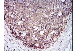 Immunohistochemical analysis of paraffin-embedded esophageal cancer tissues using EPCAM mouse mAb with DAB staining.