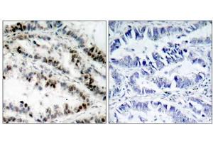 Immunohistochemical analysis of paraffin-embedded human lung carcinoma tissue using SMC1 (phospho-Ser957) antibody (E011198). (SMC1A 抗体  (pSer957))