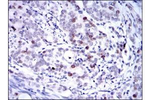 Immunohistochemical analysis of paraffin-embedded cervical cancer tissues using KID mouse mAb with DAB staining. (KIF22 抗体)