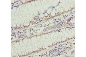 Immunohistochemistry of paraffin-embedded human colon cancer using ABIN7171004 at dilution of 1:100 (SOCS4 抗体  (AA 1-270))
