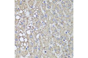 Immunohistochemistry of paraffin-embedded human liver injury using PIK3C2A antibody (ABIN5995585) at dilution of 1/100 (40x lens). (PIK3C2A 抗体)