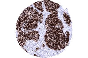 Pancreas Acinar cell carcinoma showing strong GP 2 immunostaining of all tumor cells (GP2 抗体  (AA 35-179))