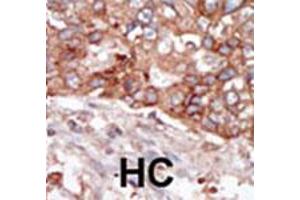 Formalin-fixed and paraffin-embedded human hepatocellular carcinoma tissue reacted with BLK polyclonal antibody  , which was peroxidase-conjugated to the secondary antibody, followed by AEC staining. (BLK 抗体  (N-Term))
